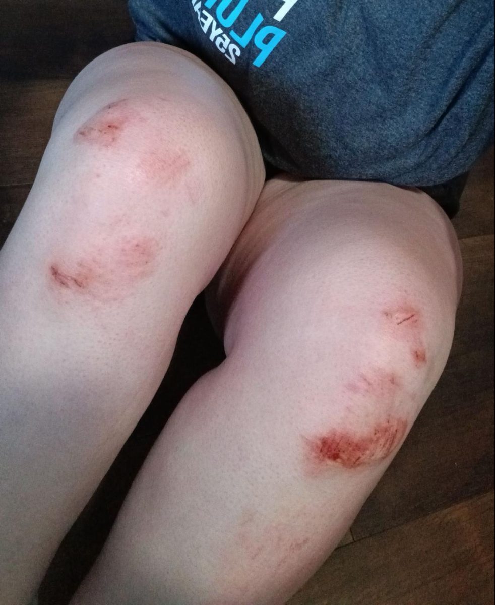 Unfortunate aftermath of falling in the water; knee edition.